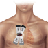 Key-hole Heart Surgery; with small incisions come great responsibilities