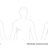FAQs for Patients having Endoscopic Heart Valve surgery