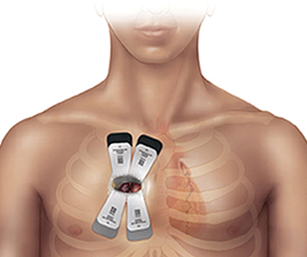 Key-hole Heart Surgery; with small incisions come great responsibilities