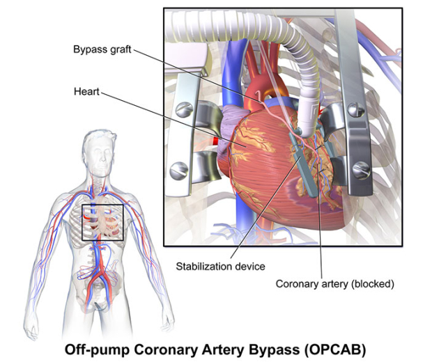 Off Pump Coronary Artery Bypass Surgery. Why does it work in practice but not in theory!