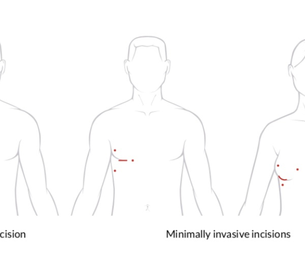 FAQs for Patients having Endoscopic Heart Valve surgery