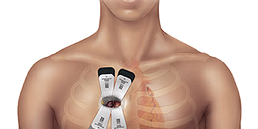 Key-hole Heart Surgery; with small incisions come great responsibilities
