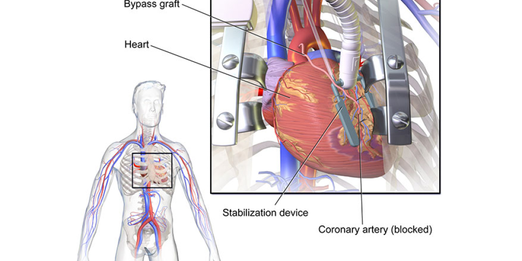 Off Pump Coronary Artery Bypass Surgery. Why does it work in practice but not in theory!