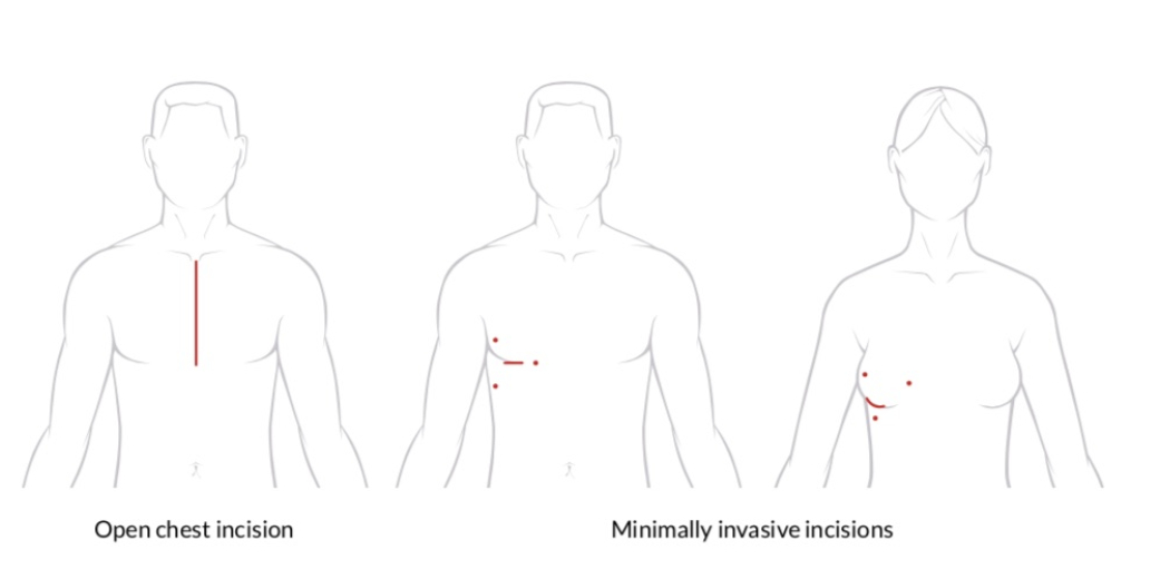 FAQs for Patients having Endoscopic Heart Valve surgery