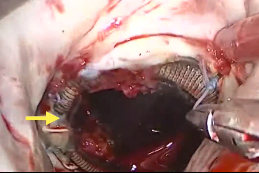 Fourth Cardiac Procedure: Redo Endoscopic Mitral Surgery for a Stuck Leaflet.