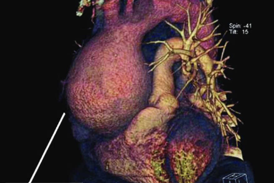 Giant aneurysm of the ascending aorta.
