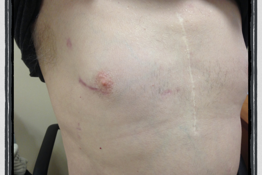 The old midline sternotomy scar is seen along with the more recent Minithoracotomy scar