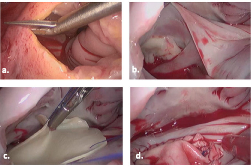Endoscopic Minimally Invasive Atrial Septal Defect closure.