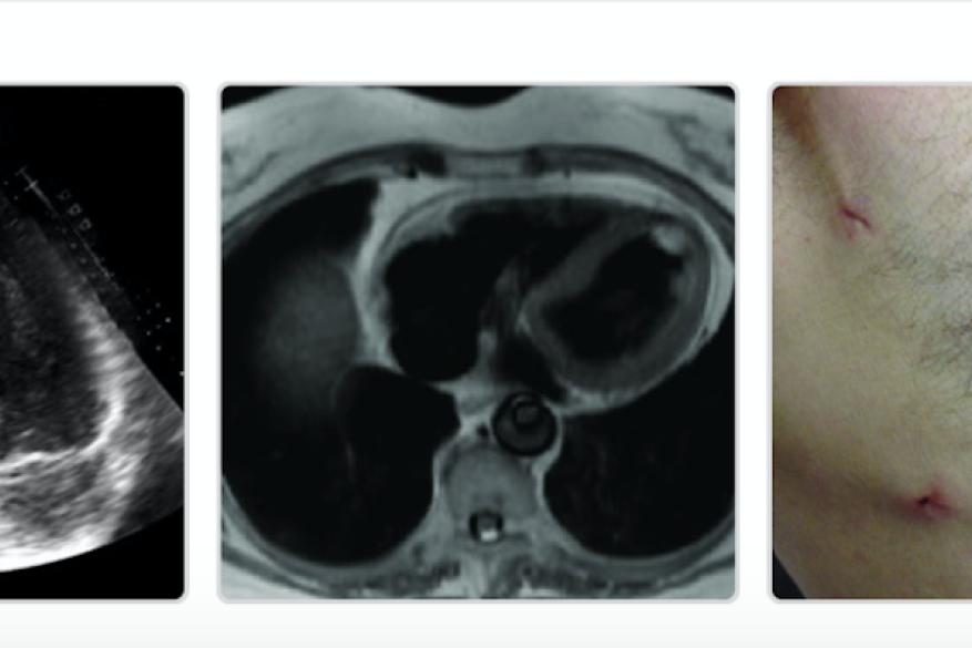 Minimally invasive resection of benign cardiac tumors.