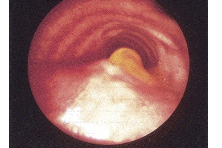 Congenital tracheo-esophageal fistula presenting in adults. Presentation of two cases and a synopsis of the literature. J Thorac Cardiovasc Surg