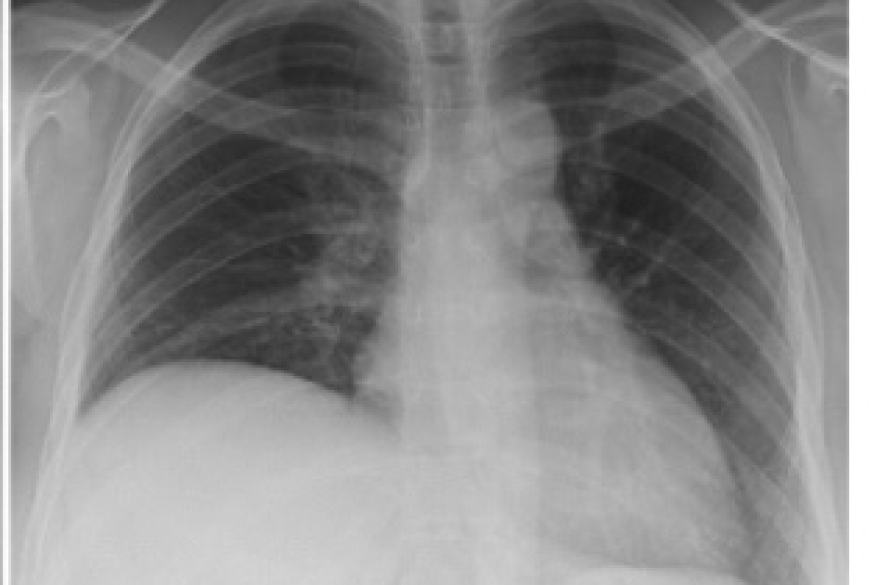 Melkersson-Rosenthal syndrome: An unusual cause of intermittent raised hemidiaphragm?