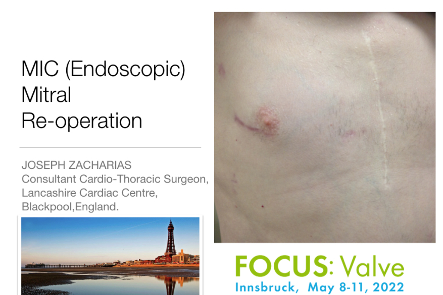 Invited lecture at Focus Valve 22, Innsbruck, Austria, on Redo MIC mitral surgery