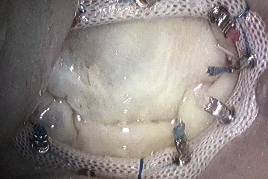 Endoscopic mitral valve surgery