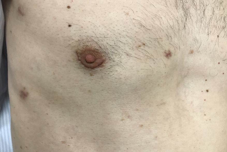Endoscopic tricuspid valve surgery