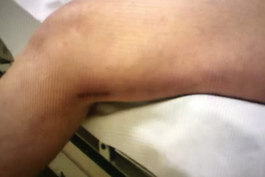 The scar left after endoscopic vein harvesting for CABG.