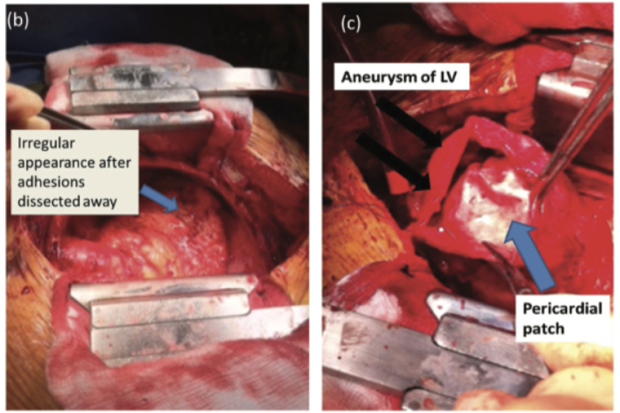 A life-saving case of Dressler’s syndrome European Heart Journal: Acute Cardiovascular Care 2048872612452319.