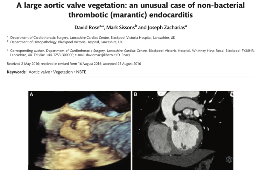 A large aortic valve vegetation: an unusual case of non-bacterial thrombotic (marantic) endocarditis.
