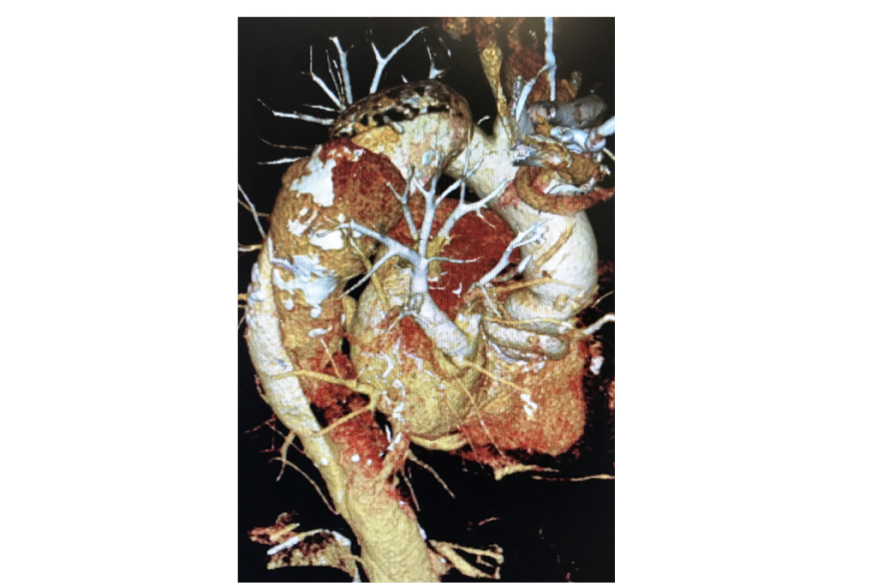 An Endoscopic Solution to Mitral Regurgitation in a Complex Patient With Marfan Syndrome.