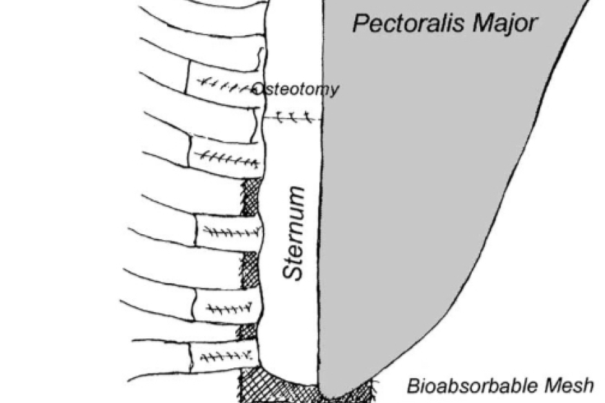 Ten year experience of bioabsorbable mesh support in pectus excavatum repair. Br J Plast Surg. 
