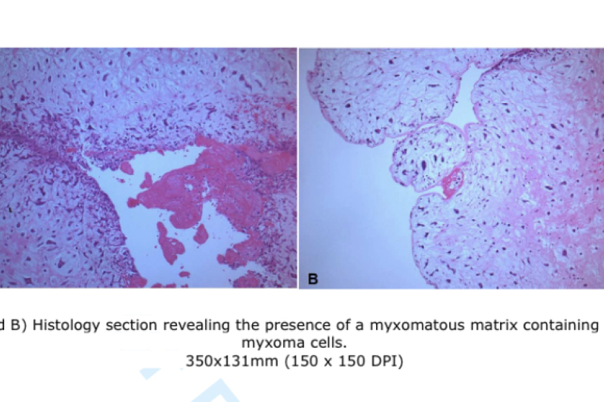 Cerebral Metastases in Patients with Left Atrial Myxoma. 