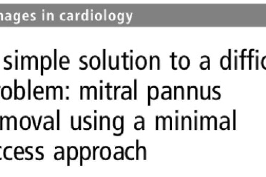 A simple solution to a difficult problem: mitral pannus removal using a minimal access approach.
