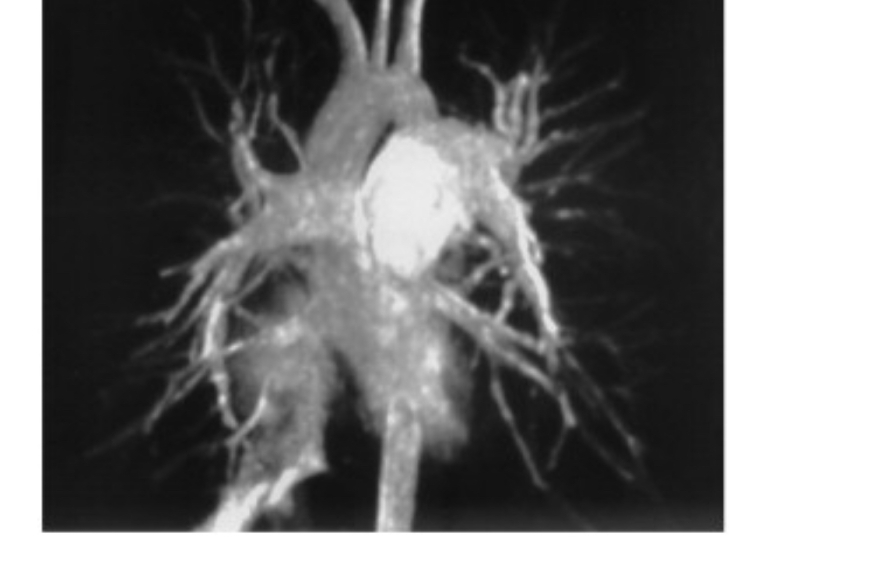 Pulmonary thromboendarterectomy in a ten year old child, for iatrogenic pulmonary hypertension.J Thorac Cardiovasc Surg. 