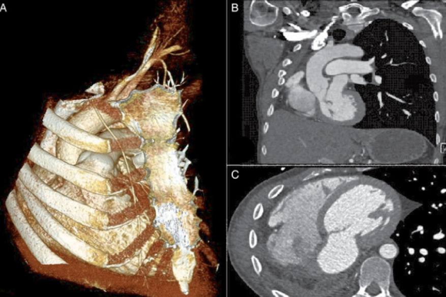 Mitral valve repair after a right pneumonectomy: a minimally invasive approach.