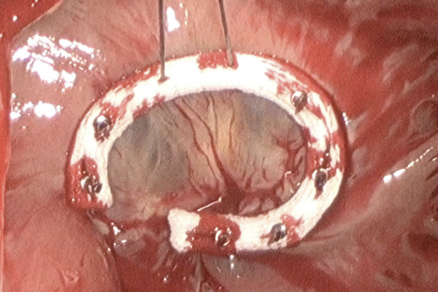 Endoscopic Tricuspid Valve Surgery is a Safe and Effective Option.