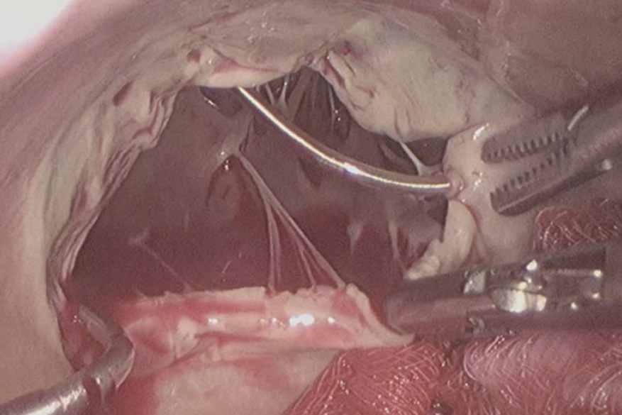 Minimally invasive tricuspid valve surgery.