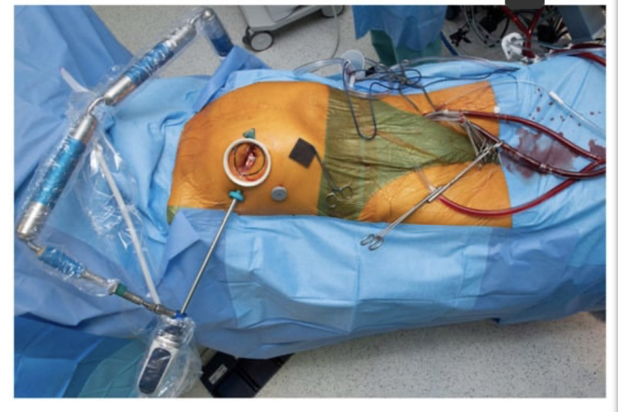 Minimal Access Tricuspid Valve Surgery