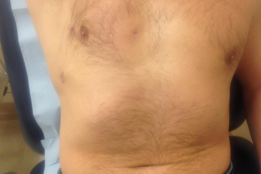 Endoscopic mitral valve surgery | Incision for Endoscopic Mitral valve surgery