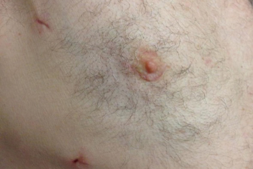 Periareolar scar after cardiac tumour excision