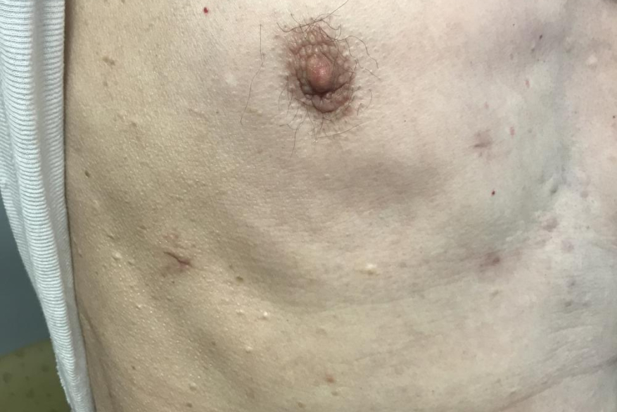 Endoscopic mitral valve surgery | Periareolar incision scars after 3 months