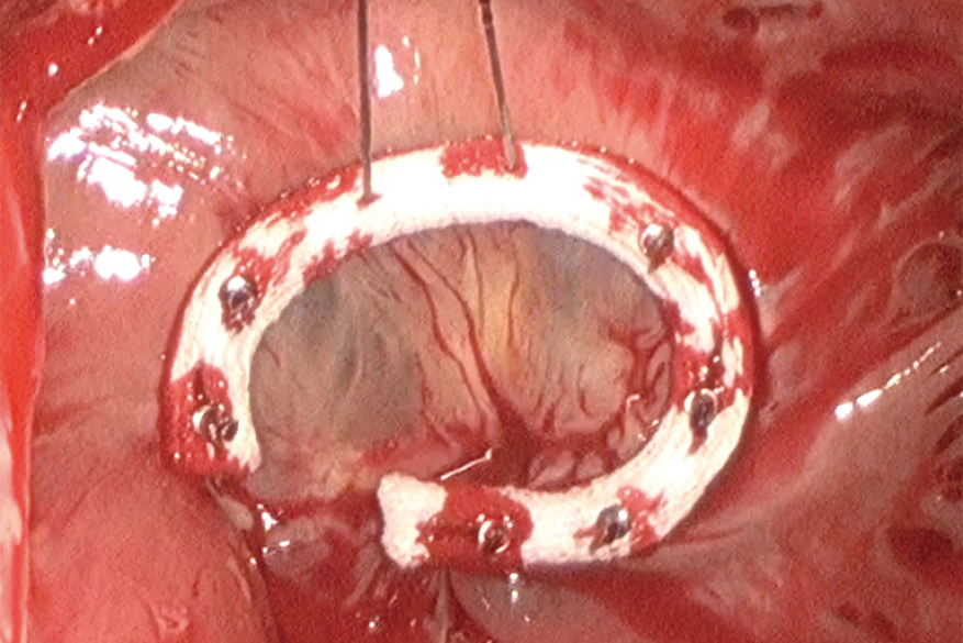 Tricuspid Valve Repair