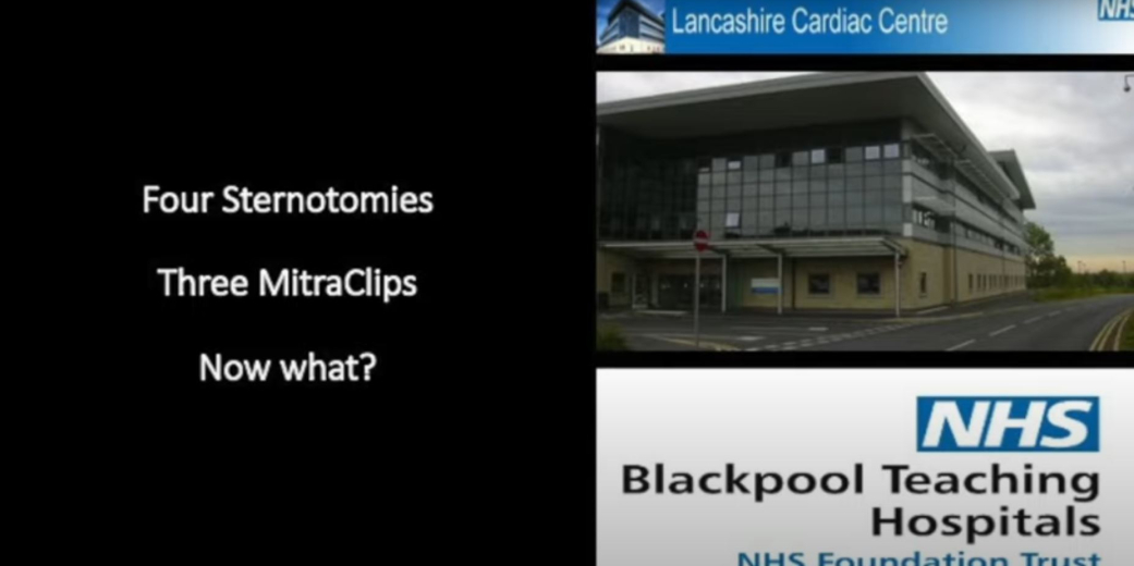 Four Sternotomies, Three MitraClips: Now What?