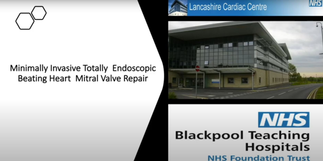 Minimally Invasive Totally Endoscopic Beating Mitral Valve Repair