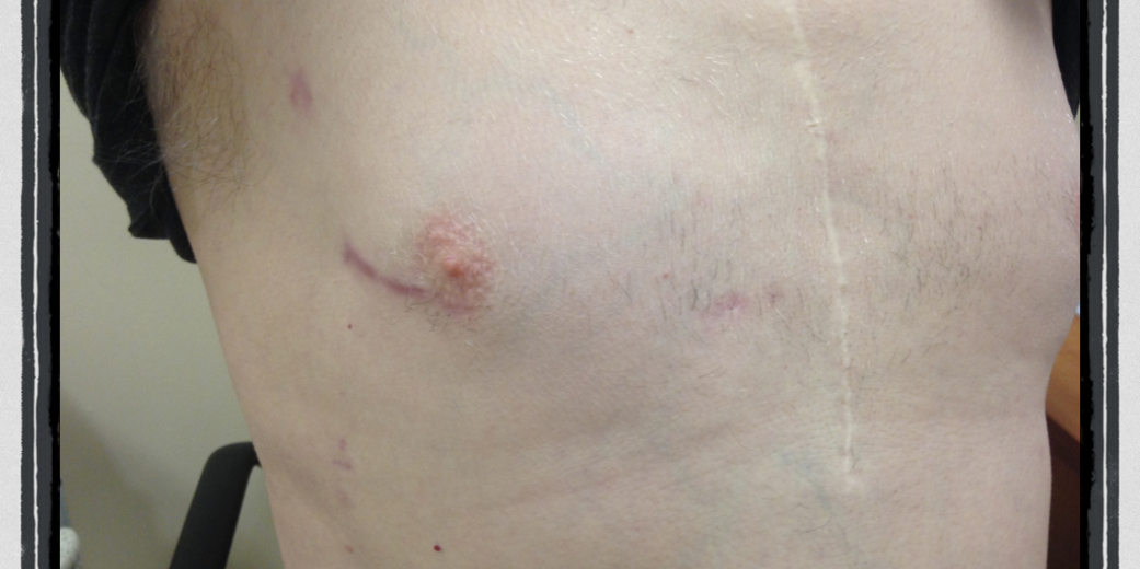 The old midline sternotomy scar is seen along with the more recent Minithoracotomy scar