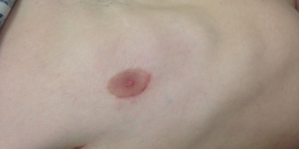 Periareolar scar at 3 months after an ASD closure