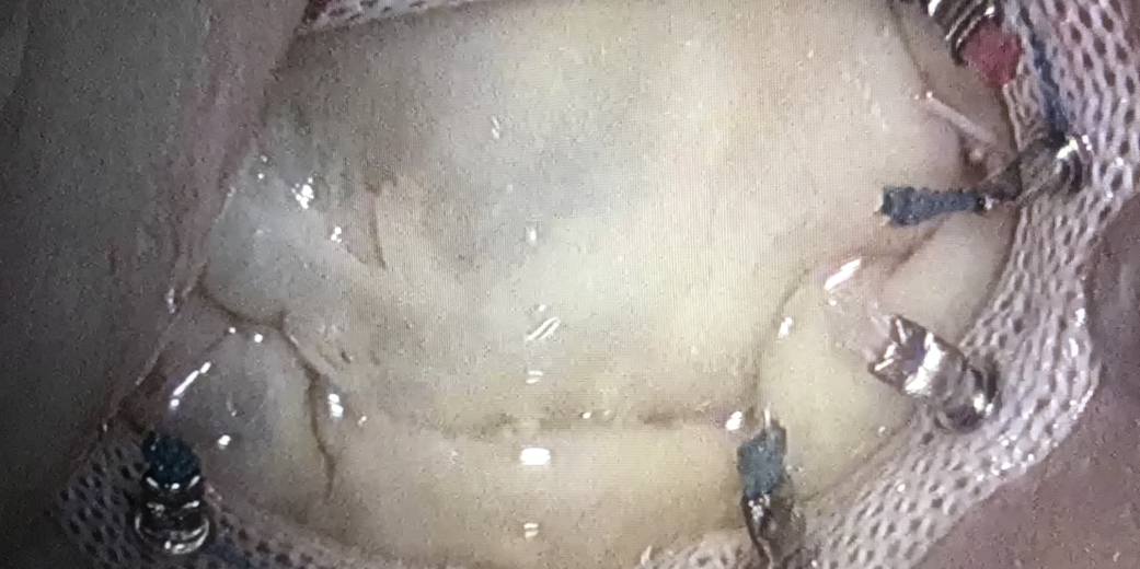 Endoscopic mitral valve surgery