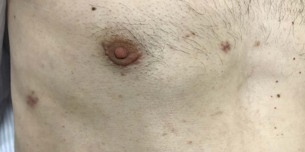 Endoscopic tricuspid valve surgery