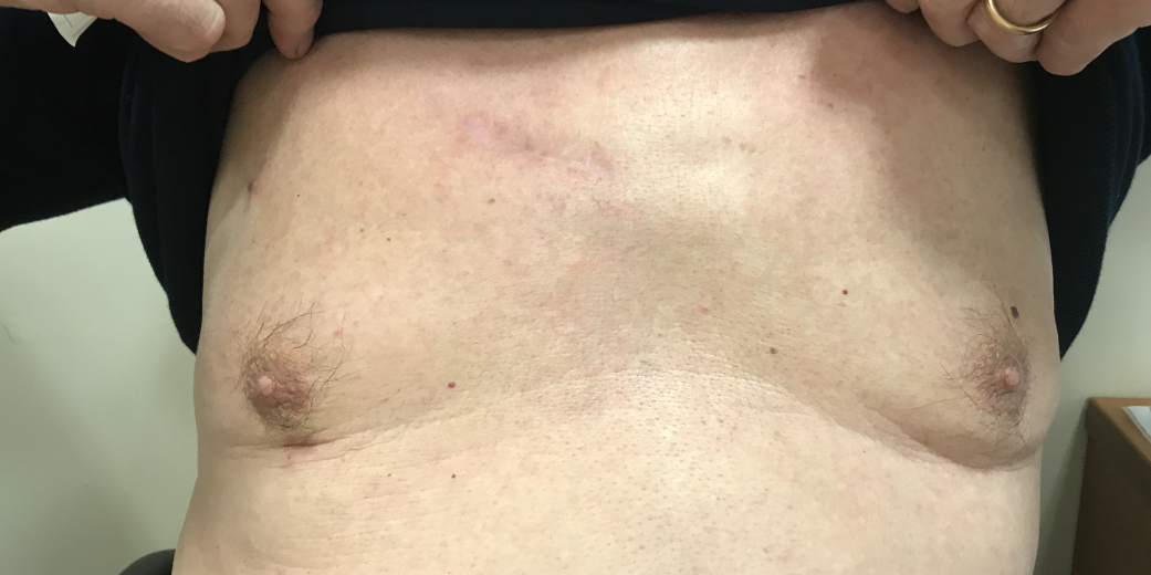 The scar at 3 months after an ART procedure for an aortic valve replacement
