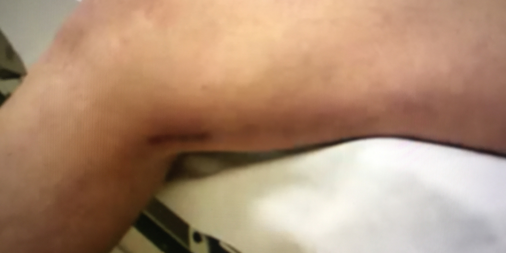 The scar left after endoscopic vein harvesting for CABG.