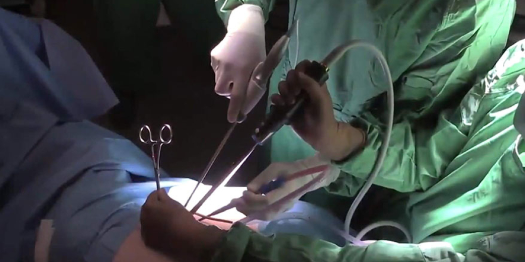 Endoscopic (VATS) surgery of Mediastinal masses