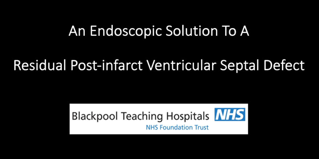 An Endoscopic Solution to a Residual Postinfarct Ventricular Septal Defect